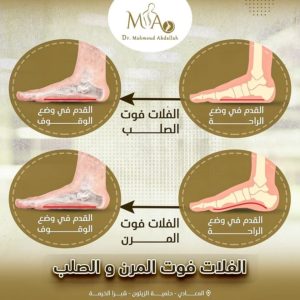 أعراض الفلات فوت