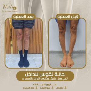 عمليات الشق العظمي للركبة