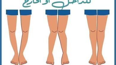تقوس الساقين للخارج