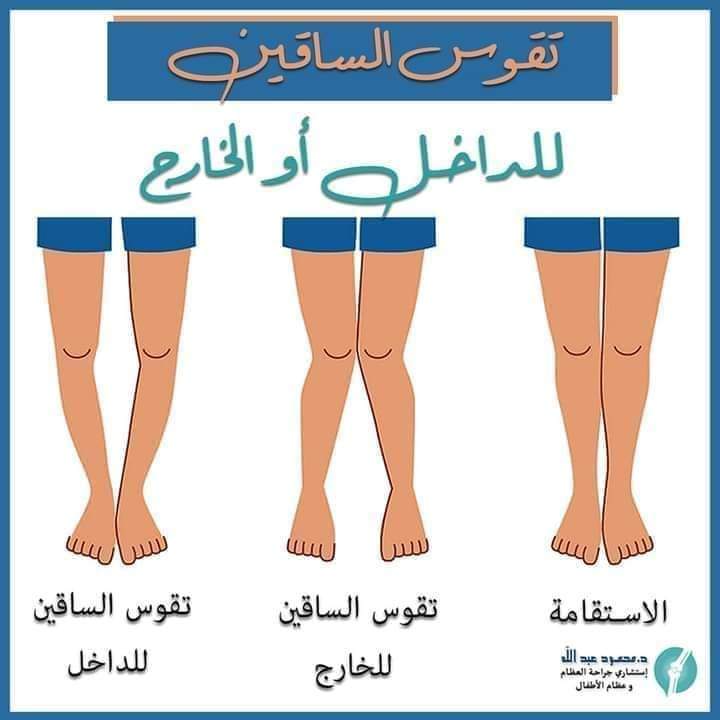 تقوس الساقين للخارج