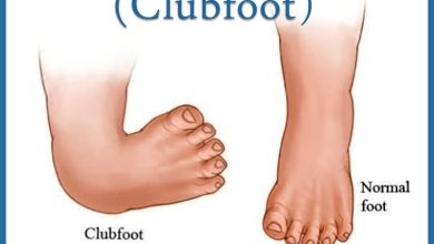 القدم المخلبية