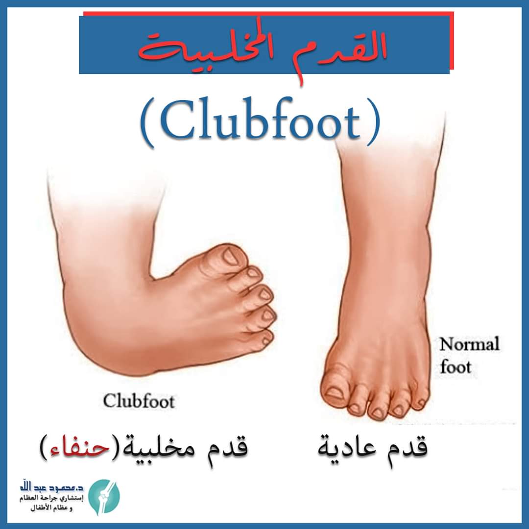 القدم المخلبية