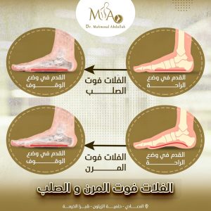 الفلات فوت المرن