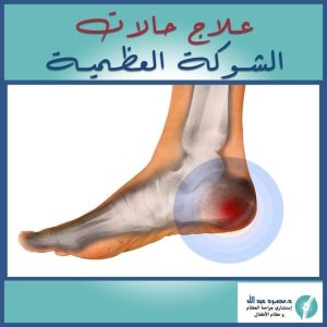 الشوكة العظمية في الكعب