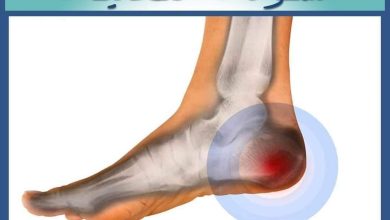 الشوكة العظمية في الكعب