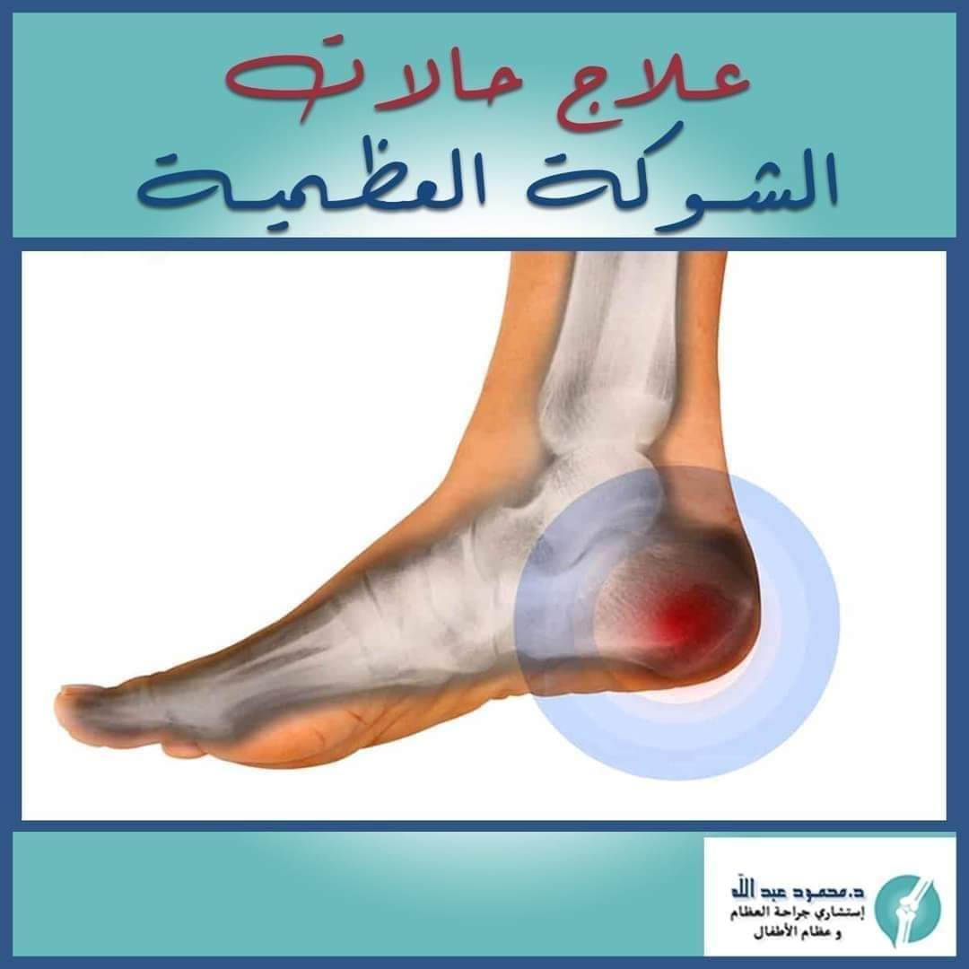 الشوكة العظمية في الكعب