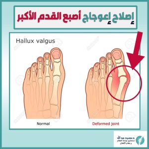 اعوجاج الإصبع الأكبر للقدم