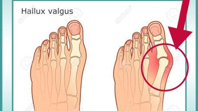 اعوجاج الإصبع الأكبر للقدم