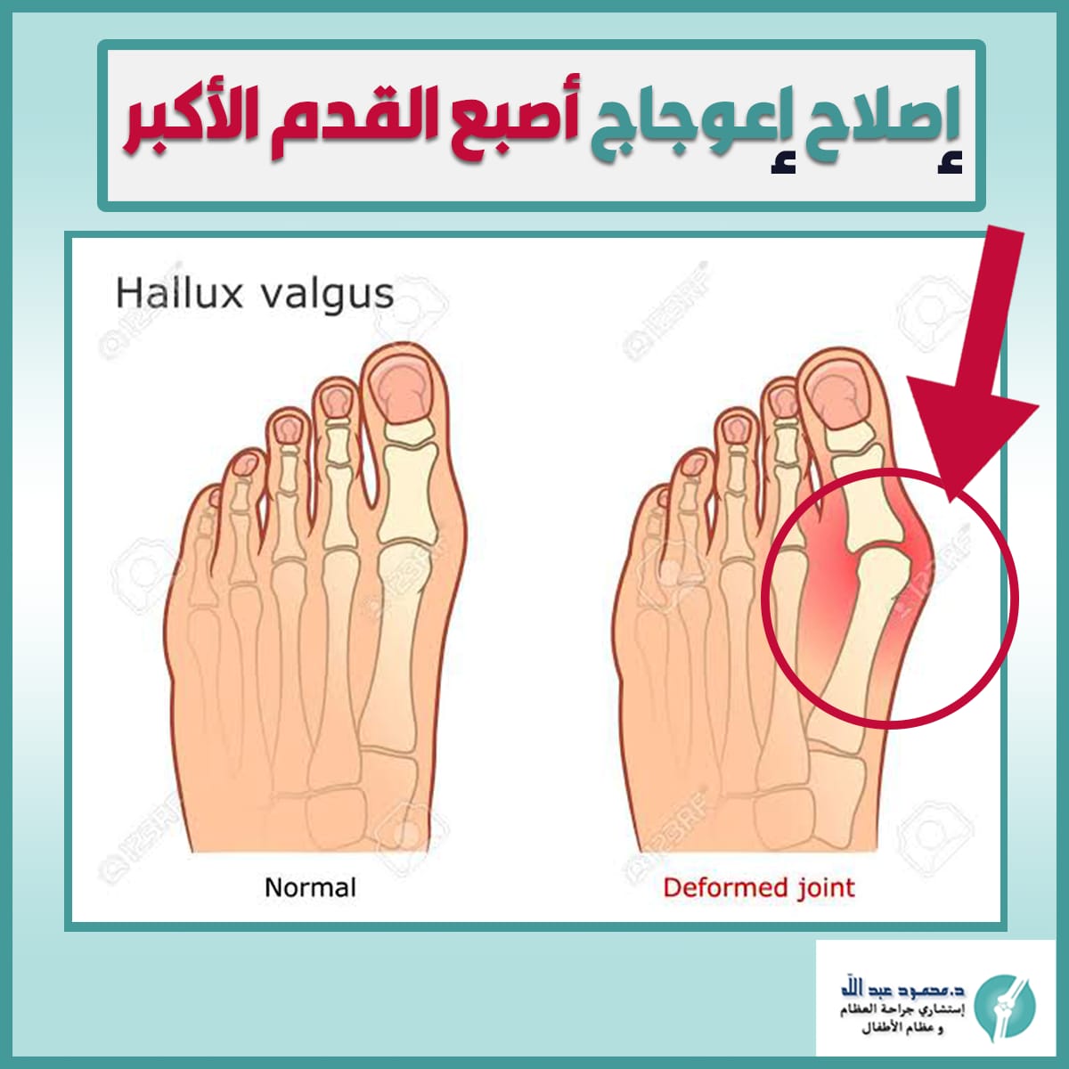 اعوجاج الإصبع الأكبر للقدم