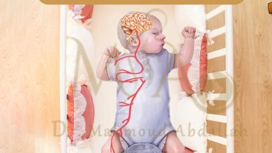 إطالة الأوتار في حالات الشلل الدماغي