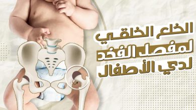 خلع مفصل الورك