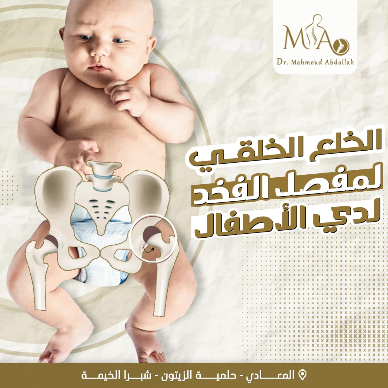 خلع مفصل الورك