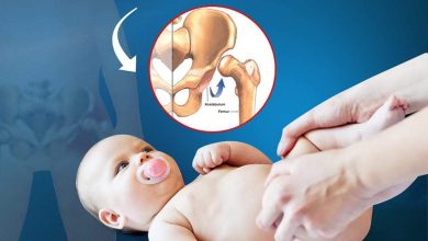 خلع مفصل الورك