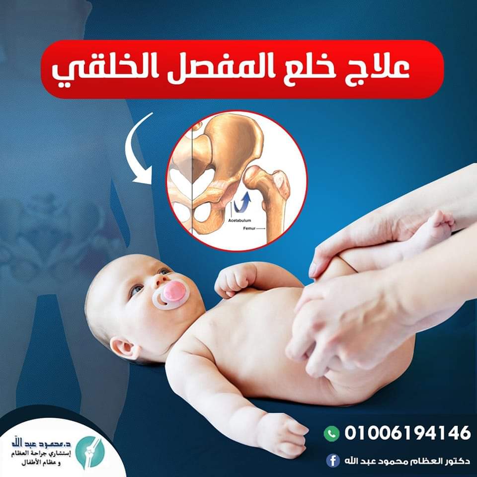 خلع مفصل الورك