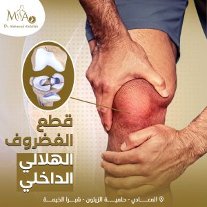 قطع الغضروف الهلالي