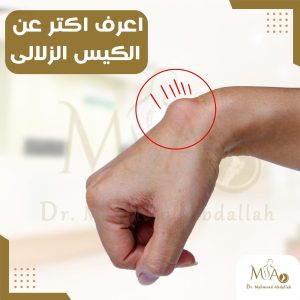 الكيس الزلالي في الرسغ