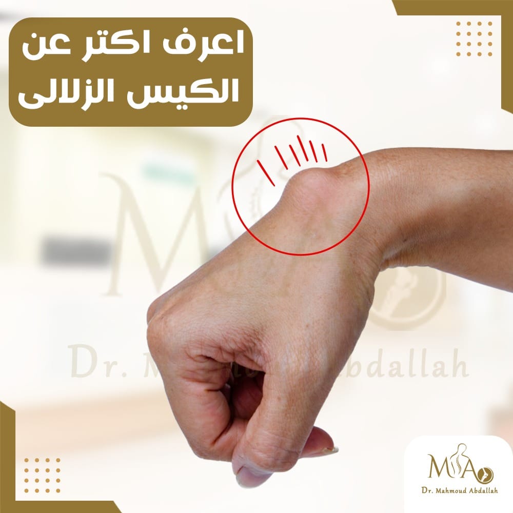 الكيس الزلالي في الرسغ