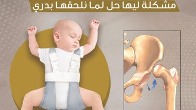 الخلع الوركي الخلقي (DDH)