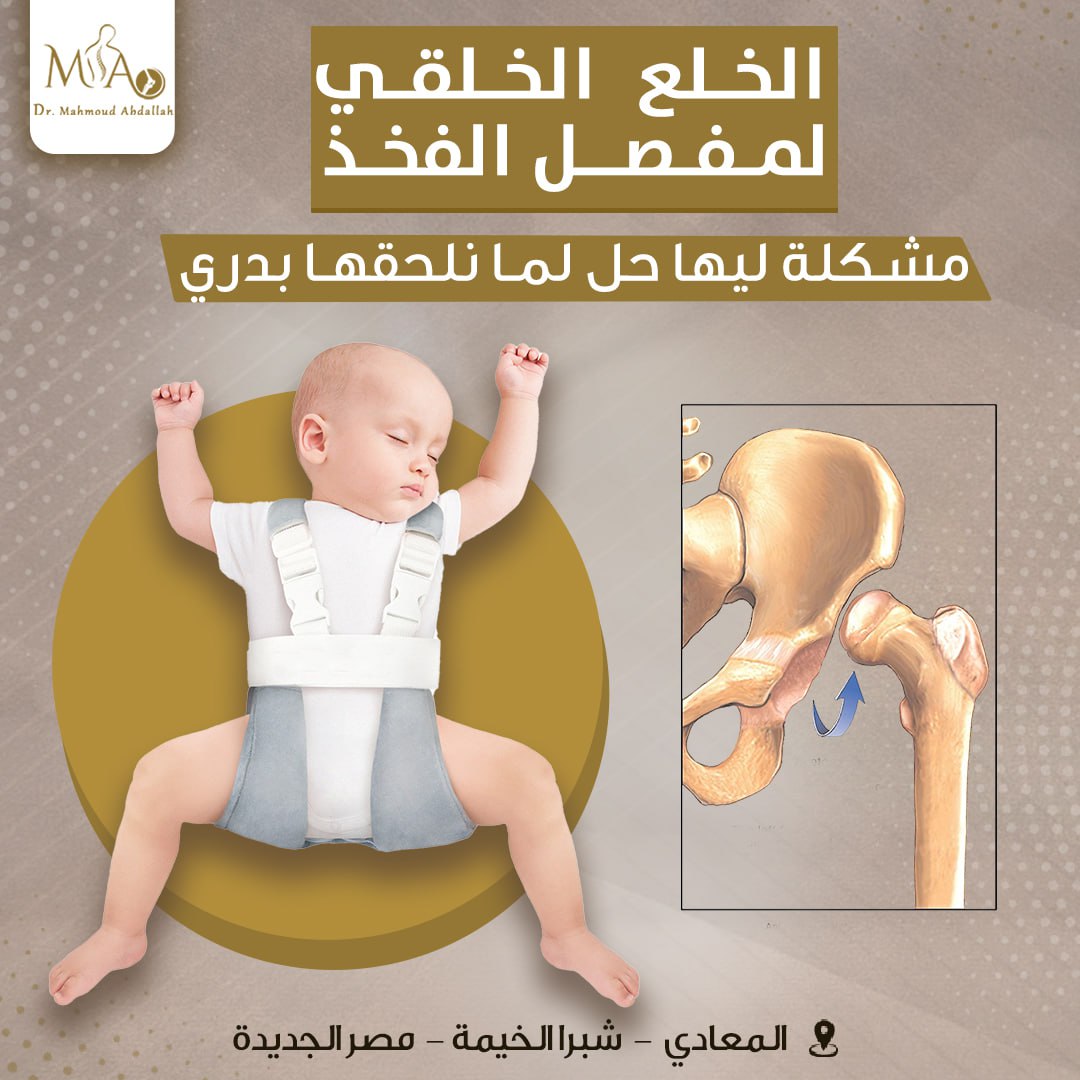 الخلع الوركي الخلقي (DDH)